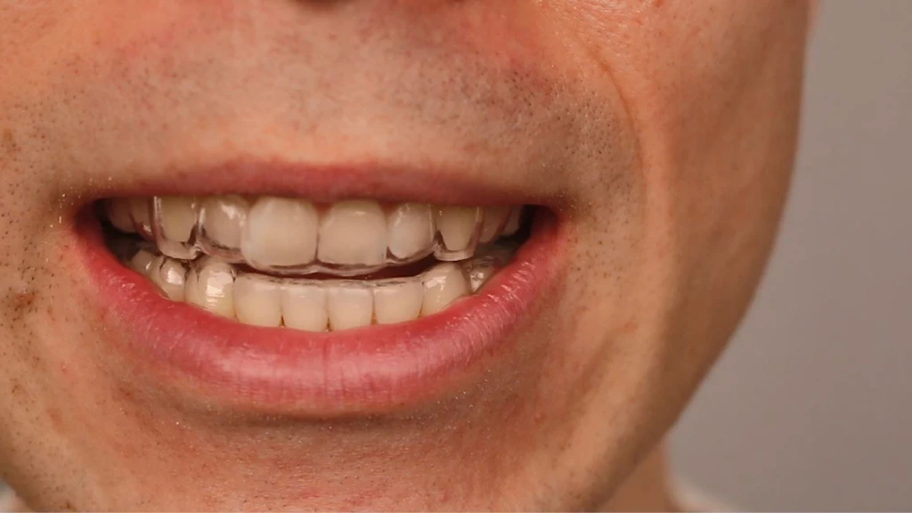 Невидимые брекеты — крупный бизнес, несмотря на то, что иногда повреждают зубы пациентов